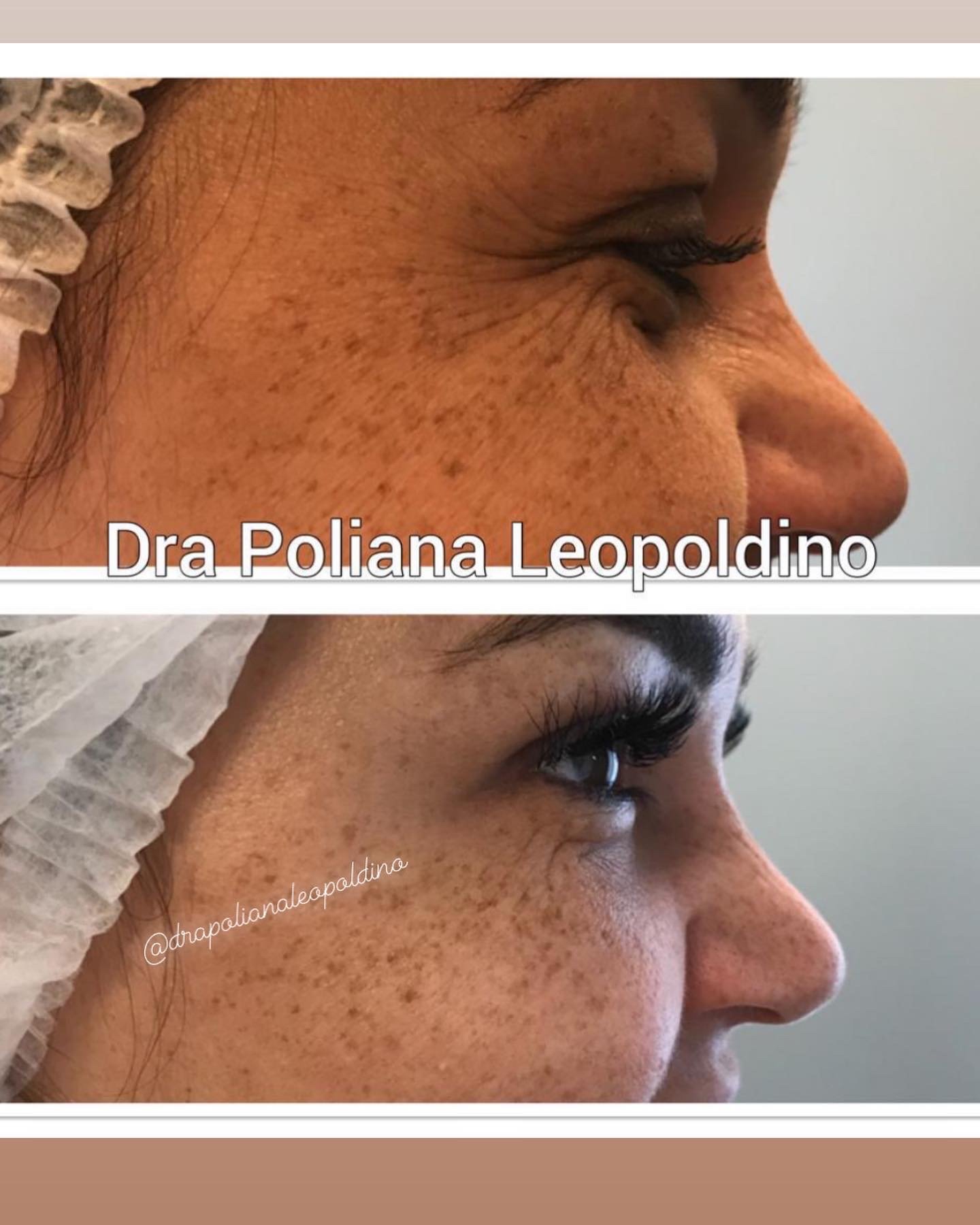 botox-facial-01