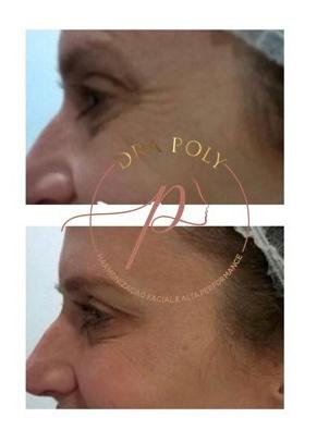 botox-facial-02