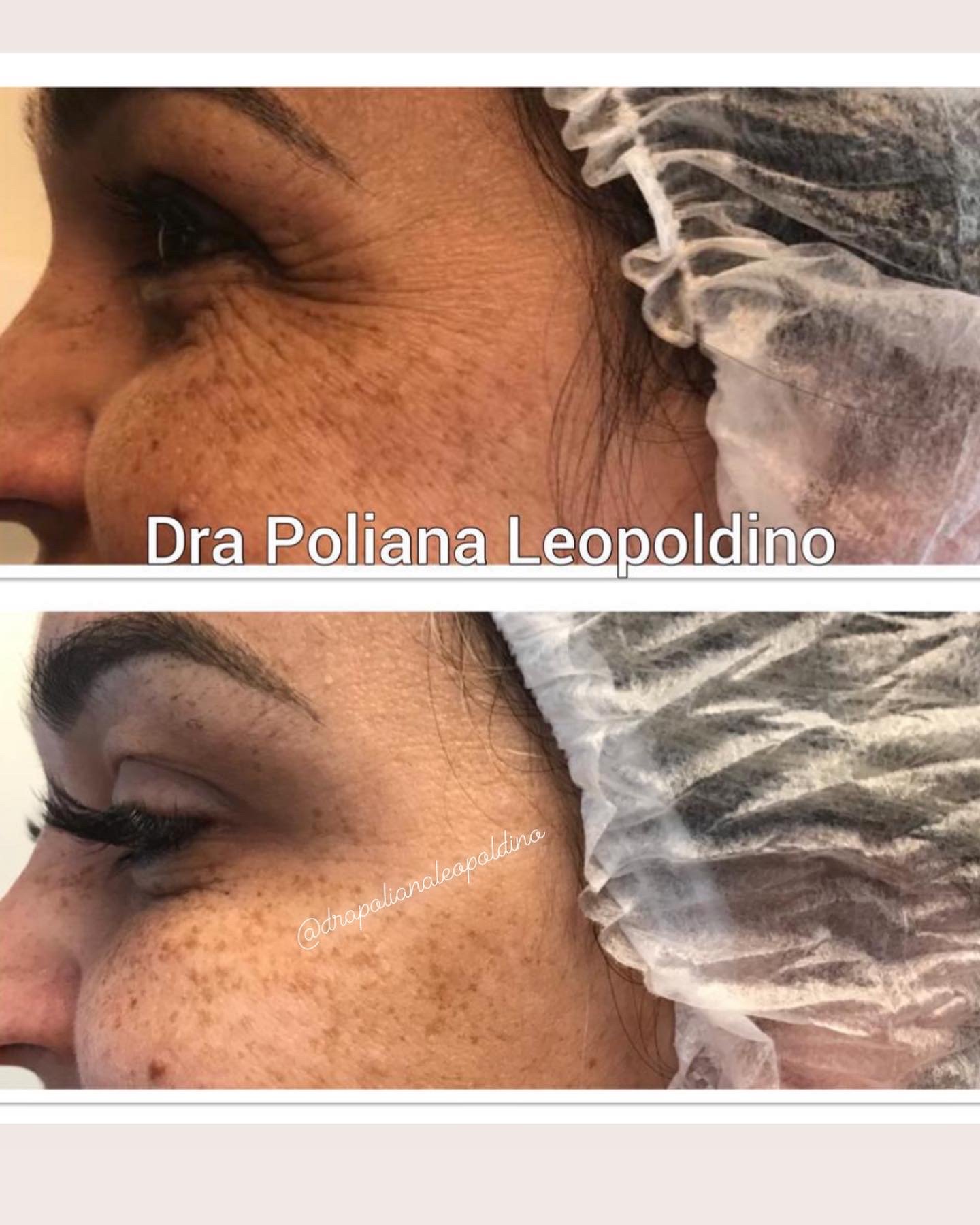 botox-facial-03