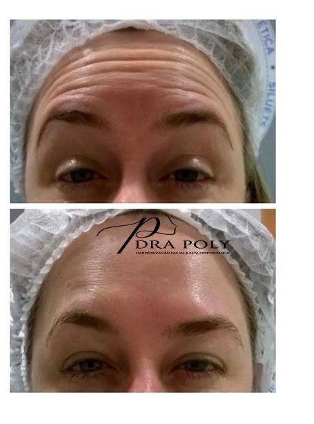 botox-facial-04