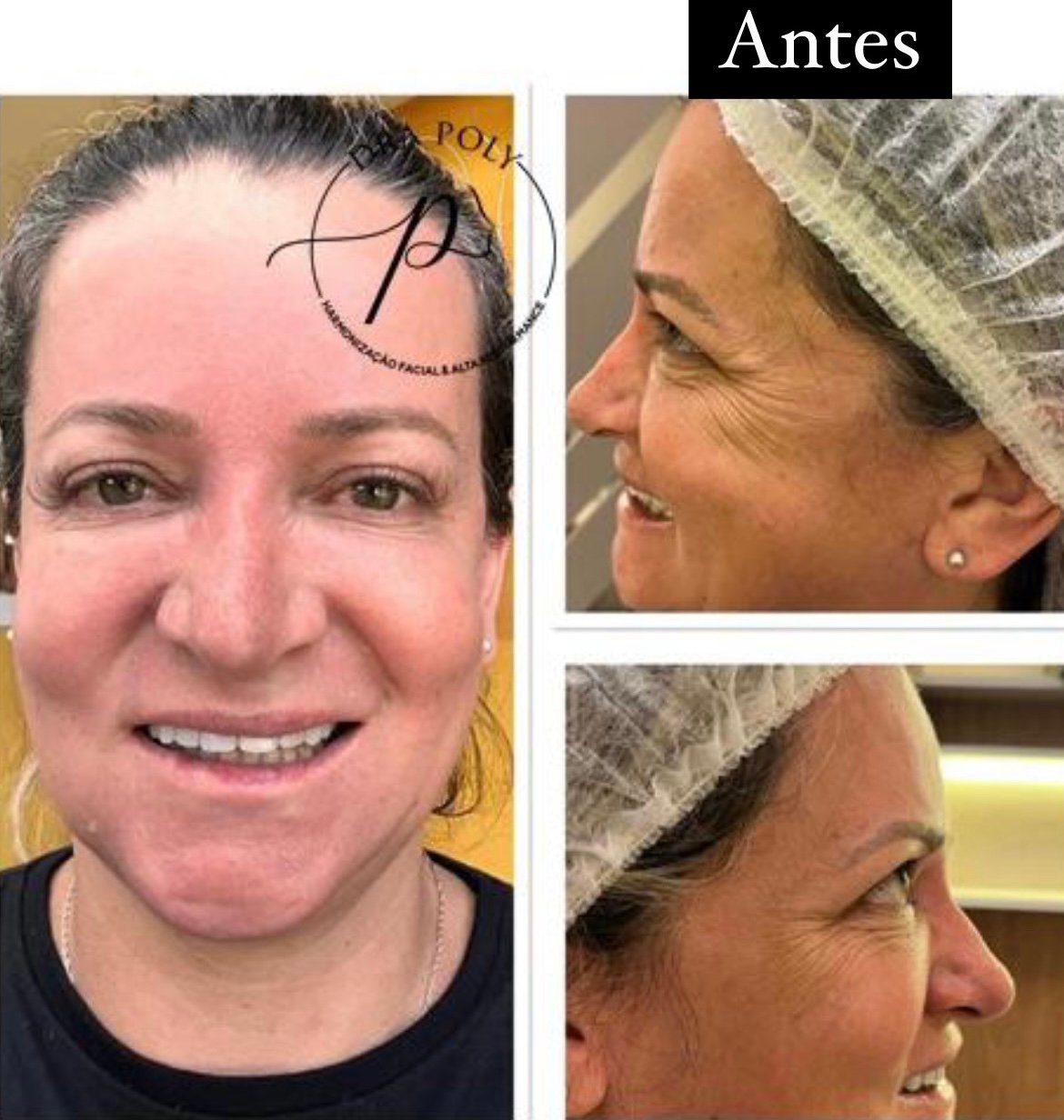 botox-facial-05