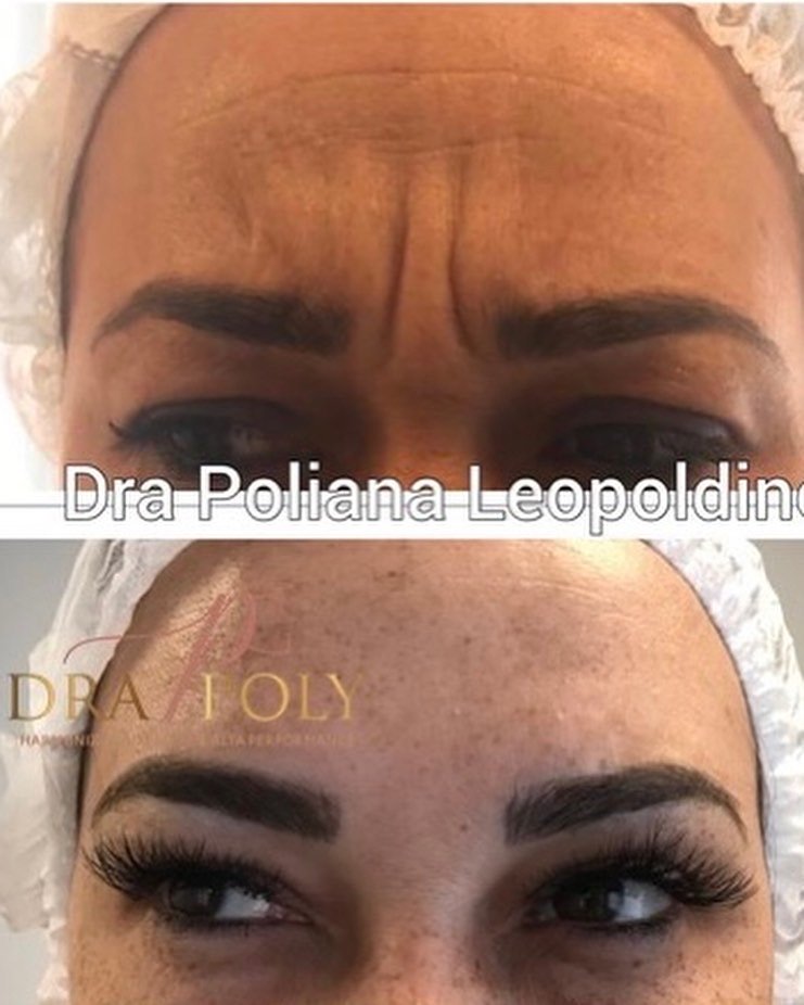 botox-facial-06