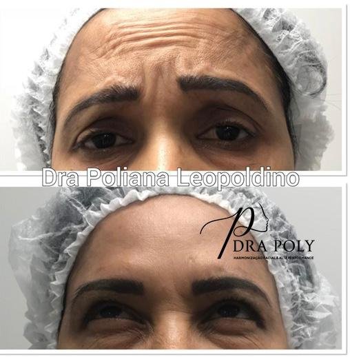 botox-facial-07
