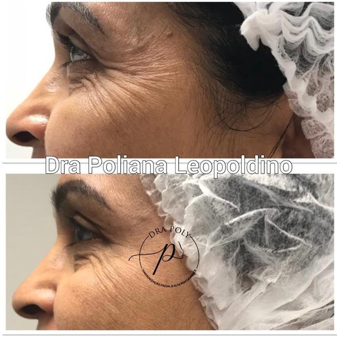 botox-facial-08