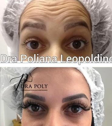 botox-facial-09