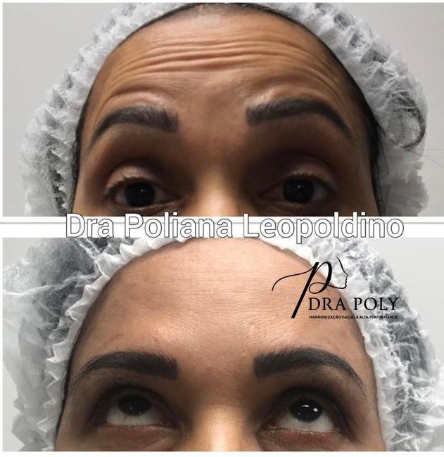 botox-facial-10