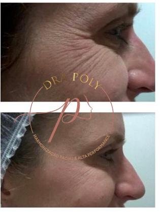 botox-facial-11