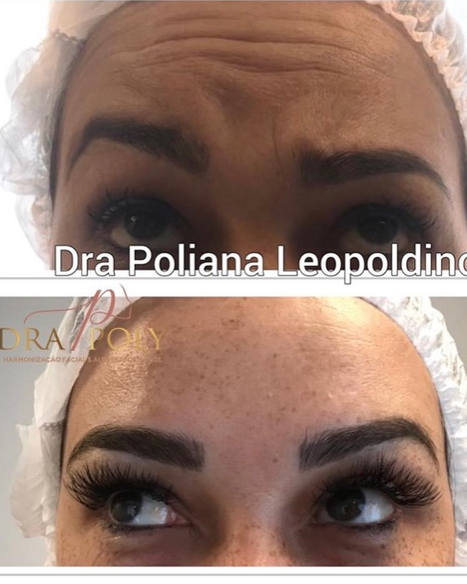 botox-facial-12