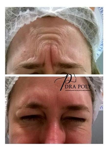 botox-facial-13