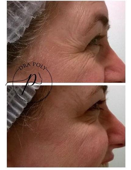 botox-facial-15