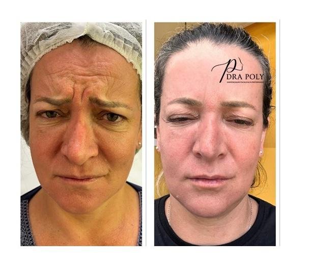 botox-facial-16