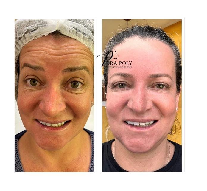 botox-facial-17
