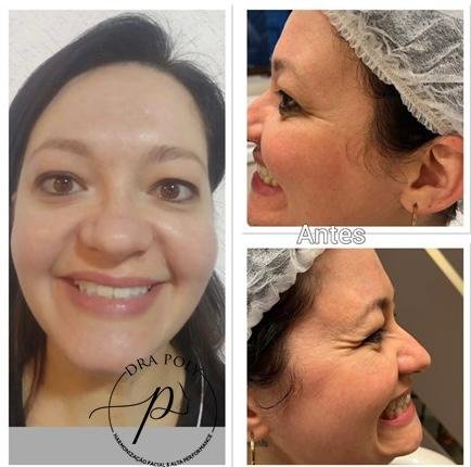 botox-facial-18