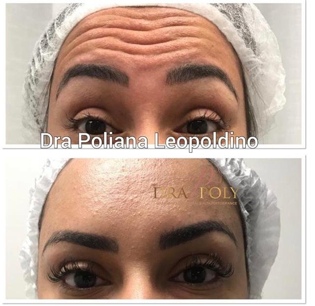 botox-facial-19