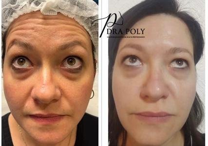 botox-facial-20