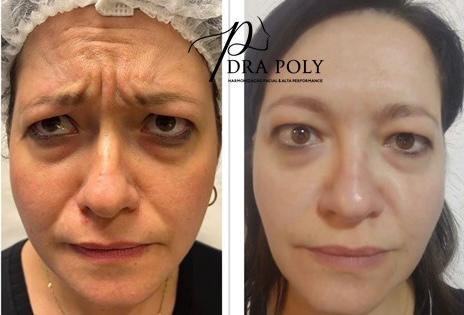 botox-facial-21