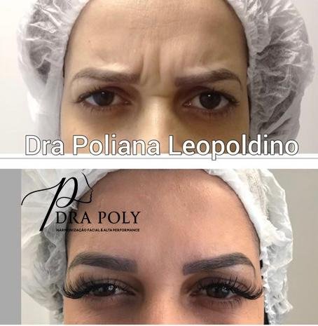 botox-facial-22