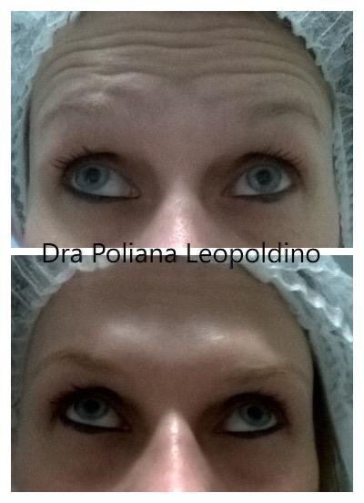 botox-facial-001