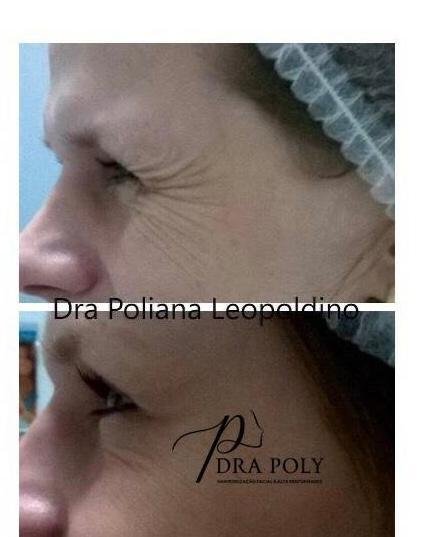 botox-facial-002
