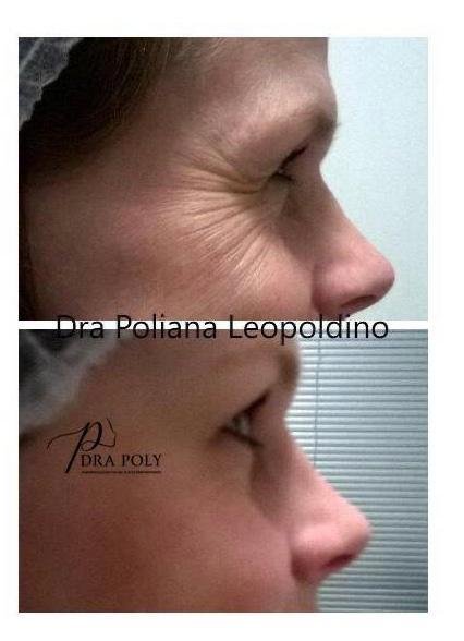 botox-facial-003